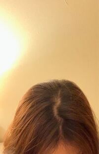 代女です 頭皮がすごくオイリーで ニキビができるうえ 抜 Yahoo 知恵袋