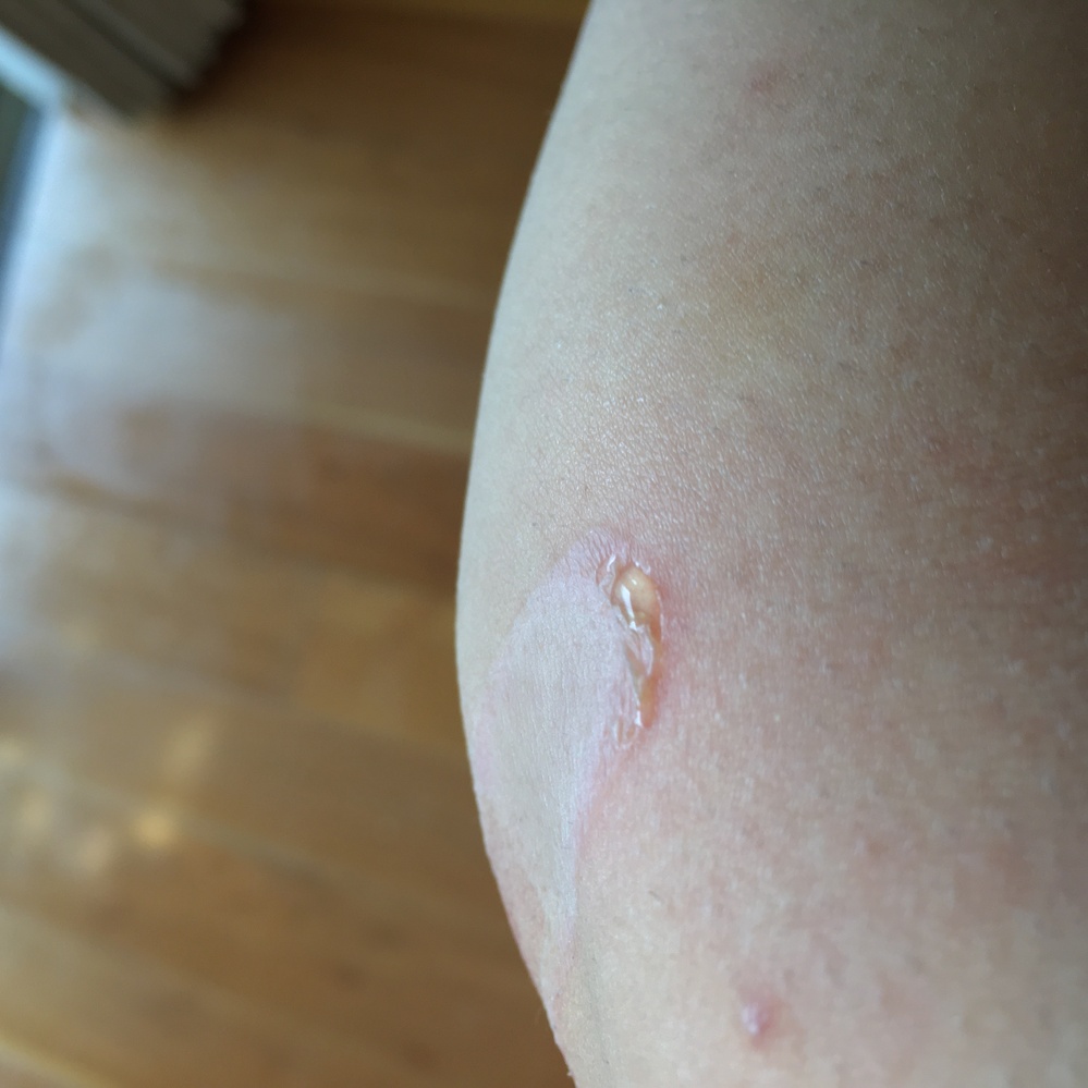 皮膚の病気 アトピー 解決済みの質問 Yahoo 知恵袋