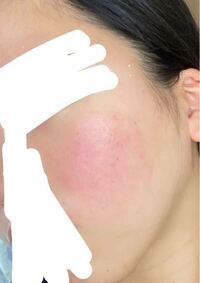 これは脂漏性皮膚炎でしょうか 皮膚科に行ったら日光湿疹だと言われたので Yahoo 知恵袋