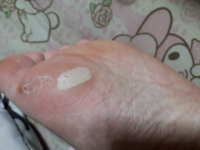 この足の裏の白いものって マメですか こんばんは 少し似たような質問を Yahoo 知恵袋