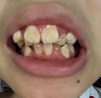 観覧注意 高校生1年生です 私は歯並びが絶望的に悪いです 矯正はお金 Yahoo 知恵袋