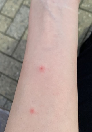 刺され ダニ 虫 画像