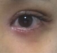 埋没で二重の手術をしました 落ち着くと 二重幅ってこれの半分 Yahoo 知恵袋