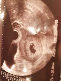 妊娠初期について 本日推定6w1dで病院に行き 胎嚢が 8mmとのこ Yahoo 知恵袋