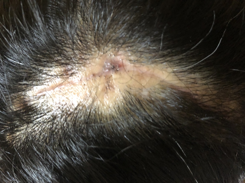 開頭手術後の縫合部の脱毛について2ヶ月前に開頭手術をしました 頭部 Yahoo 知恵袋