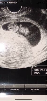 妊娠３ヶ月 9週目のエコー写真です まだまだ性別判断するには早すぎる時 Yahoo 知恵袋