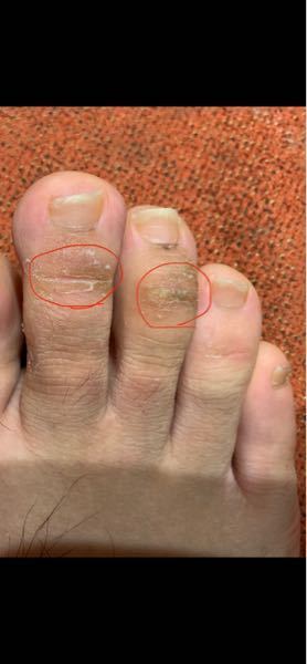 バースト 管理します 平凡 指 カサカサ 水虫 Jaefll28 Jp