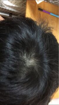 14歳です 癖毛なんですが つむじが 気になります つむじハゲでしょうか Yahoo 知恵袋