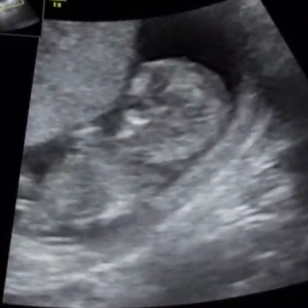 妊娠12週のときのエコー写真です エコーの1番左に写っている白い二 Yahoo 知恵袋
