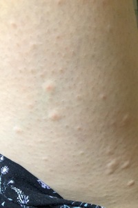 汚い画像でごめんなさい 家庭脱毛器で脱毛したら太ももの毛だけが画像のようにブ Yahoo 知恵袋