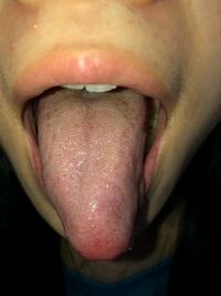この舌の奥のブツブツ 赤い斑点みたいなの何かわかる方いますか 病気ですか Yahoo 知恵袋
