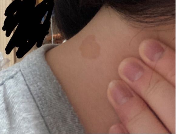 現在高校生の女子です。 - 先日、首のところにシミのようなものがある 