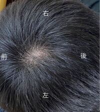 頭皮が赤いです 痒みや痛みはないです 赤い原因分かりますか 赤みのせいで Yahoo 知恵袋