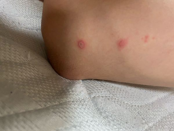 皮膚の病気 アトピー 解決済みの質問 Yahoo 知恵袋
