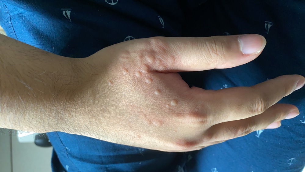 ご質問です これは卵アレルギーかコリン性蕁麻疹ですかね 分かる方教えて頂きた Yahoo 知恵袋