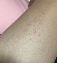 太ももに赤と言うよりは紫っぽい斑点ができてしまいました その部分以 Yahoo 知恵袋