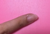 爪の横がささくれのような感じになっているのですがずっと治りません これはなん Yahoo 知恵袋