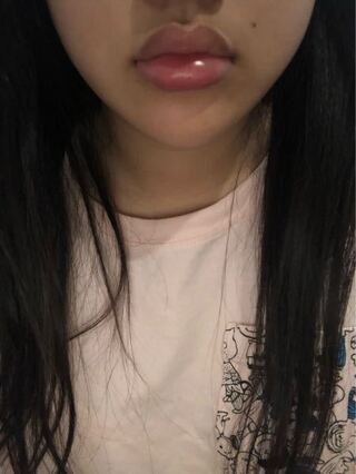 朝起きたら 下唇が腫れていました 写真 病気とかだったりするのでしょう Yahoo 知恵袋