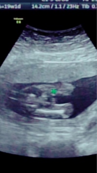エコー写真胎児の性別について妊娠19w6dです検診の時エコーみた時 Yahoo 知恵袋