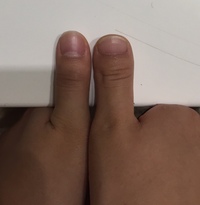 生まれた時から片方ずつ指の爪の形が違うのですが 同じような方いますか また Yahoo 知恵袋