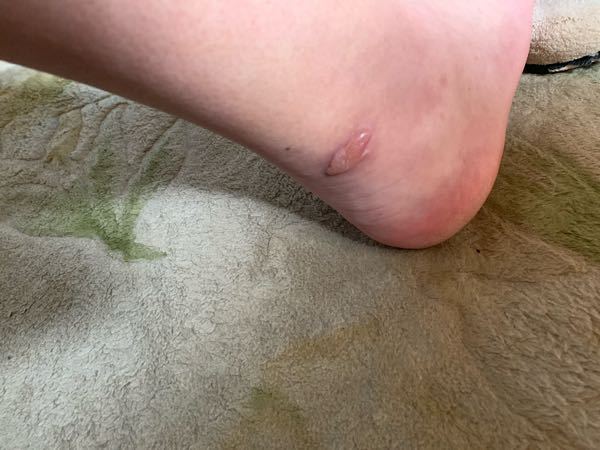 虫刺されて 塗り薬のアズノールを塗ってたんですが 水ぶくれに Yahoo 知恵袋