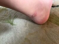 虫刺されて 塗り薬のアズノールを塗ってたんですが 水ぶくれに Yahoo 知恵袋