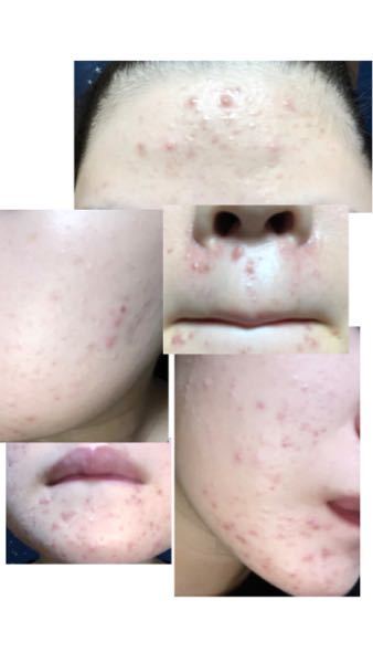 皮膚の病気 アトピー 解決済みの質問 Yahoo 知恵袋
