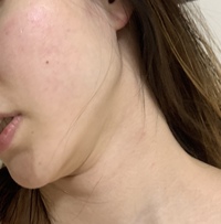 頬と顎下の脂肪吸引をしましたが まだ取れますか Yahoo 知恵袋