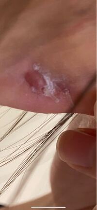 画像閲覧注意です 1年前にピアスの穴を開けました 2 3ヶ月前は穴が安 Yahoo 知恵袋