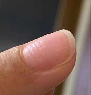 爪 でこぼこ 子供