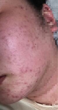 お見苦しいものを見せてすみません お酒を飲むとニキビ跡がめちゃくちゃ Yahoo 知恵袋