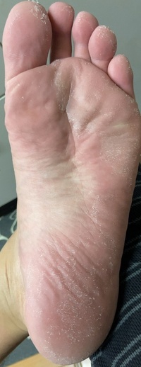 足の裏が写真のようになります 痒みはないので水虫とかではないと思い Yahoo 知恵袋