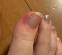 2日くらい前から足の親指の爪の横が熱くて 痛いのですが何かの病気で Yahoo 知恵袋