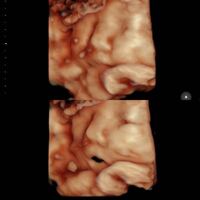 26w5d エコー写真 そうちゃん成長記録 ダウン症ボーイ