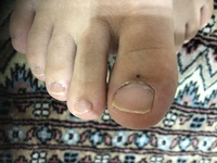 産後1ヶ月です 最近 足の親指の爪の下にホクロができました 皮膚科 Yahoo 知恵袋