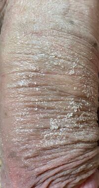 代男性です お見苦しい画像すみません 陰茎の裏筋がずっと痒いので掻 Yahoo 知恵袋