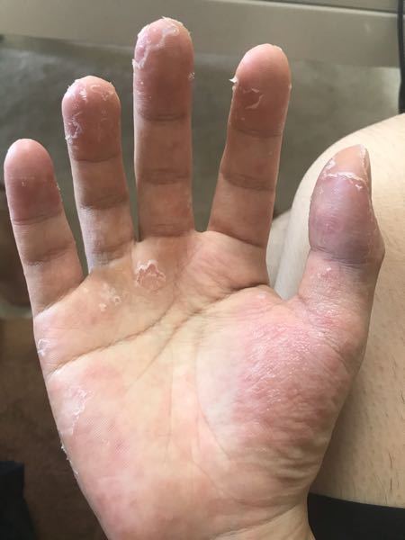初めまして 手に水虫か汗疱ができている者です この症状はひどいでしょうか 病 Yahoo 知恵袋