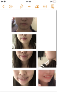 これは矯正に失敗していますか 非抜歯矯正でとても悩んでいます 4年前に非抜歯 Yahoo 知恵袋