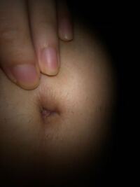 これは何ですかね綿棒で臍のゴマ掃除したら 出来物と膿が出ました 一応皮膚 Yahoo 知恵袋