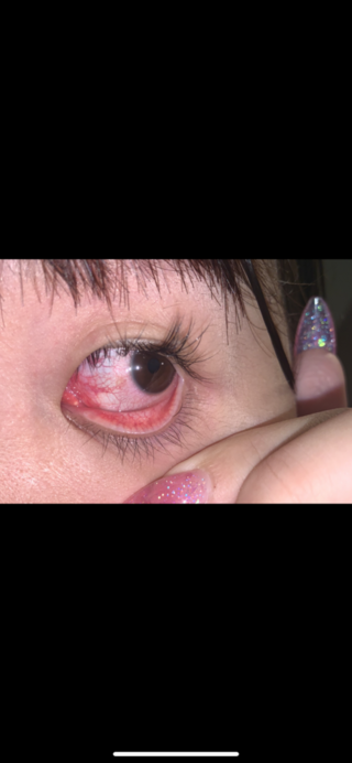 閲覧注意画像あり目がかゆいなーとおもって目を何度かかいてたらもっと Yahoo 知恵袋