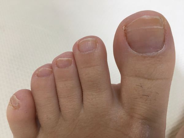 水虫 投票受付中の質問 Yahoo 知恵袋