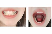 てる 犬歯 尖っ 私の歯が尖っているのはなぜ？八重歯や中心結節などの治療法についても解説