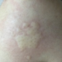 画像あり 寝て起きたら腕のひじ付近が何らかの虫に刺されてたのですが蚊でしょ Yahoo 知恵袋