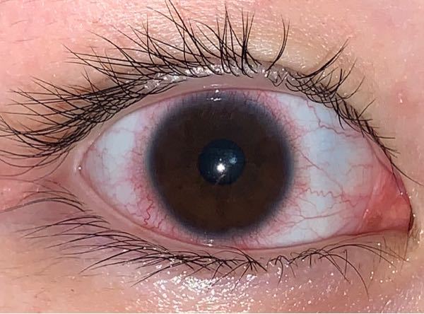 長期タイプのカラコンをつけているのですが このような目の充血は何故 Yahoo 知恵袋