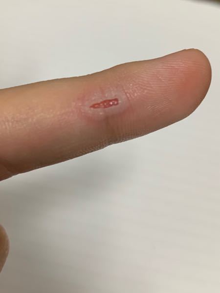 やけどにキズパワーパッドを貼ったのですが 昨日ヘアアイロンで指をや Yahoo 知恵袋