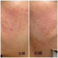 今日皮膚科でアダパレンとクリンダマイシンゲルとビーソフテンローションを貰 Yahoo 知恵袋