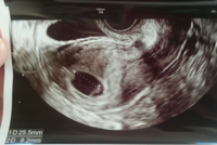 初めての妊娠で エコーの見方がわかりません 妊娠6週5日で心拍 Yahoo 知恵袋