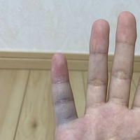 今日ドッチボールで突き指をしてしまいました 曲げるのも痛くだんだん Yahoo 知恵袋