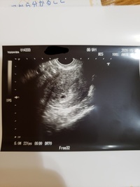 妊娠5週2日の胎嚢の大きさについて閲覧ありがとうございます ﾍﾟｺ先日 妊 Yahoo 知恵袋