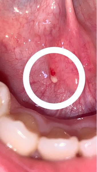 白い粒 口内炎 に関するq A Yahoo 知恵袋